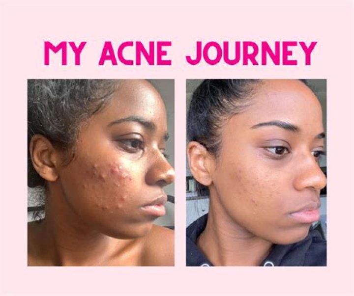 Acne Makeup Tips - Makeup Tips for People with Acne