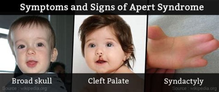 Apert Syndrome: Causes, Symptoms and Treatments