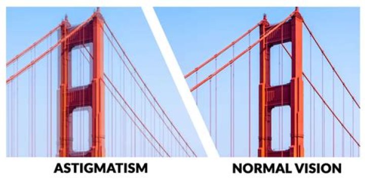 Astigmatism: Astigmatism FAQs