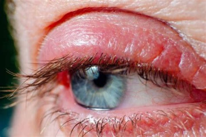 Blepharitis (Eyelid Inflammation): Symptoms, Causes and Treatment