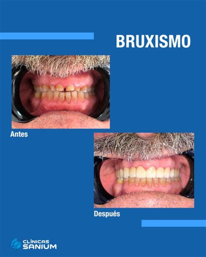 Bruxismo tratamientos, síntomas e información en CuídatePlus