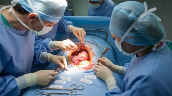 Can C-section anesthetic lead to low back pain?