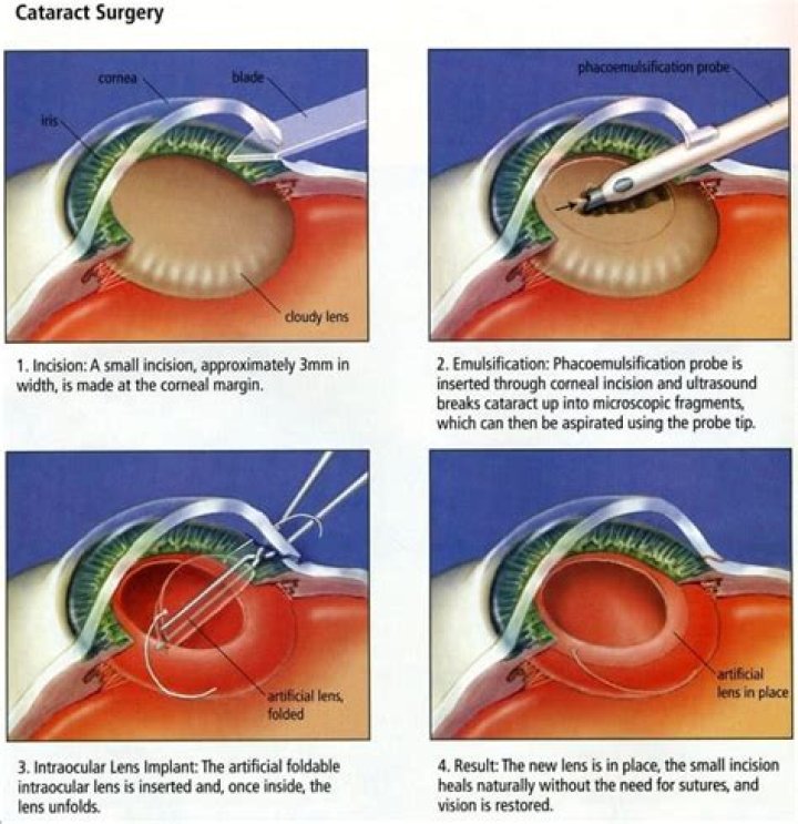 Can Cataract Surgery Correct Astigmatism?
