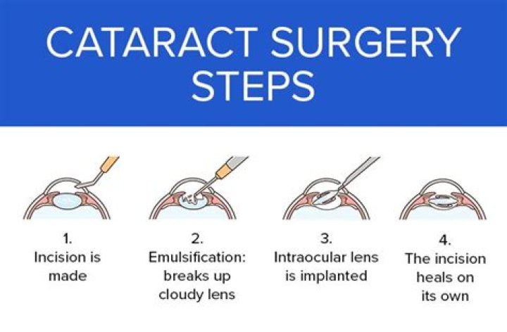 Can Cataract Surgery Correct Lazy Eye?