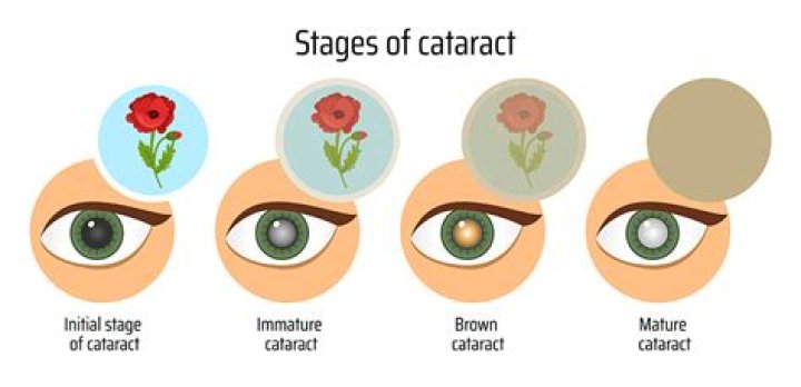Can Cataracts Cause Blindness?