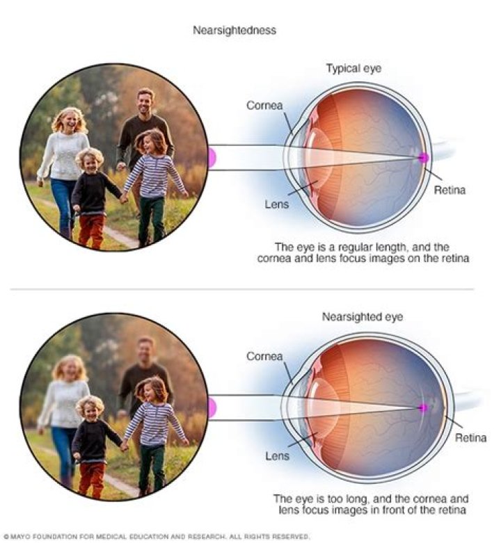 Can You Be Short-sighted in One Eye and Long-sighted in the Other?