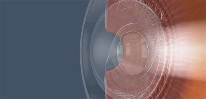 Capsulotomy - All About Vision
