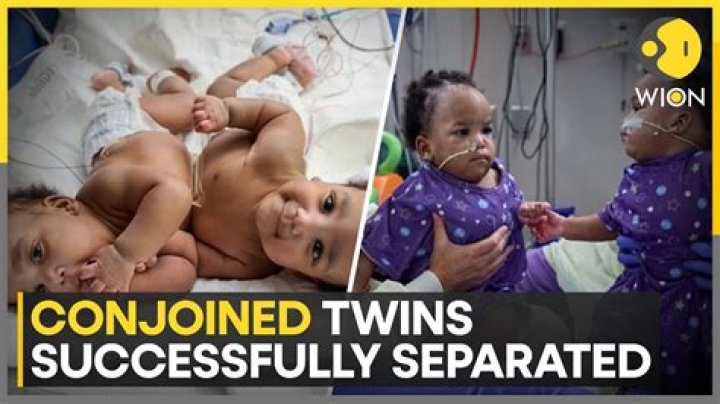 CNN.com - Prayers for lost conjoined twins