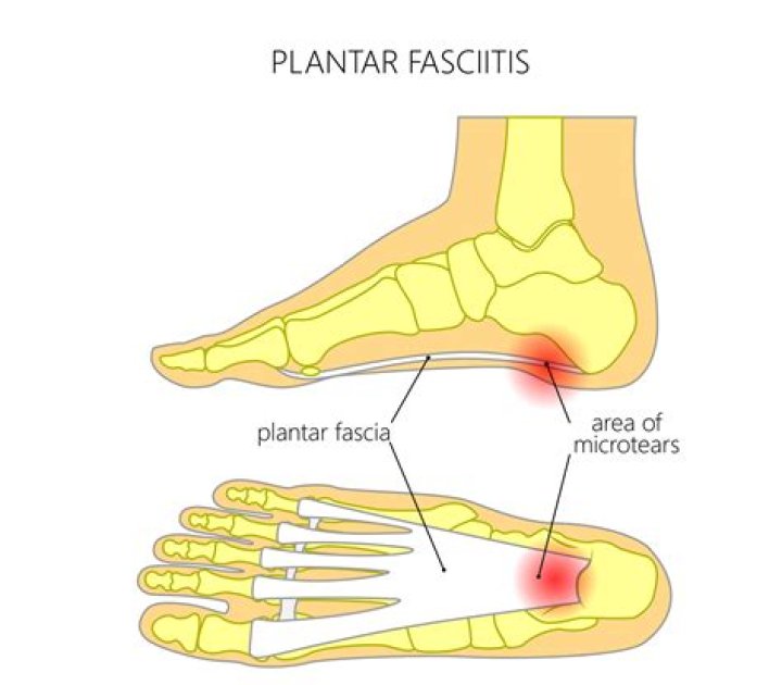 Co to jest Plantar fasciitis