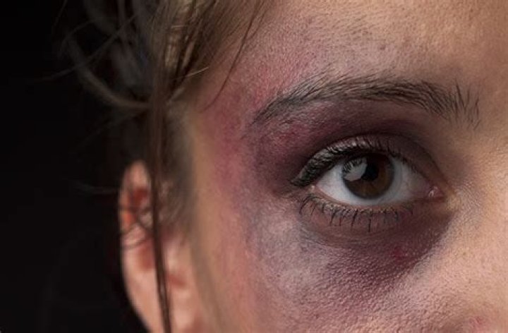 Cómo tratar el ojo morado