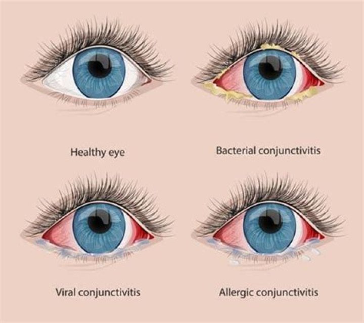 Conjunctivitis treatments | All About Vision