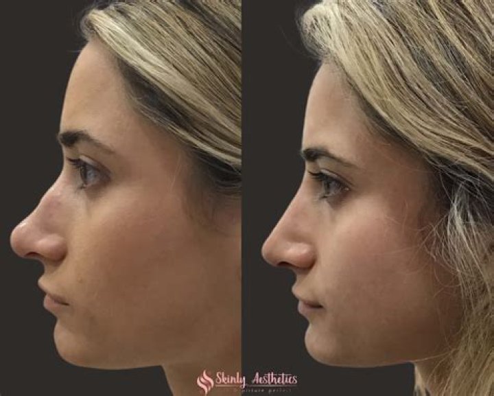 Dani Austin Nose Job: A Comprehensive Look At Her Transformation