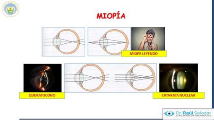 Defectos refractivos y la refracción: Cómo funciona el ojo