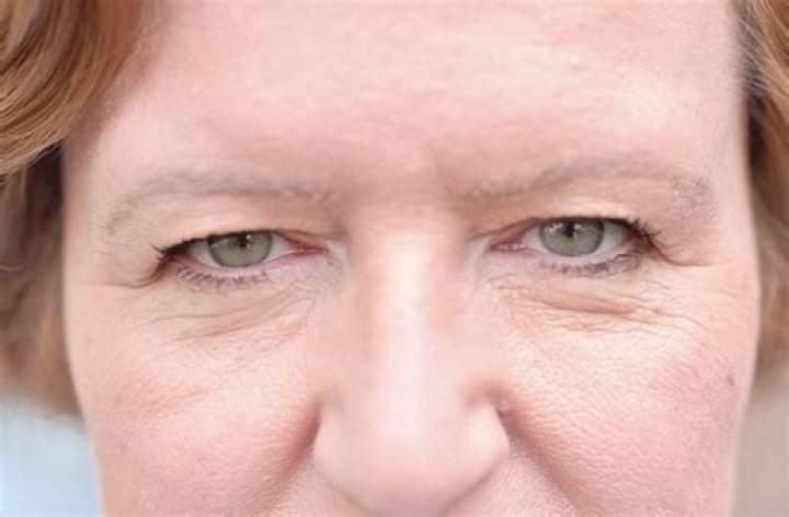 Dermatochalasis - All About Vision