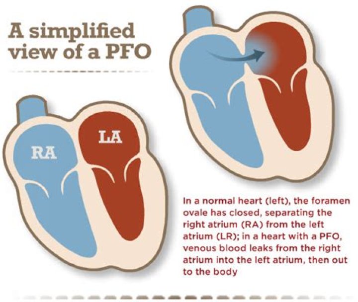 Difference Between Pfo And Pda