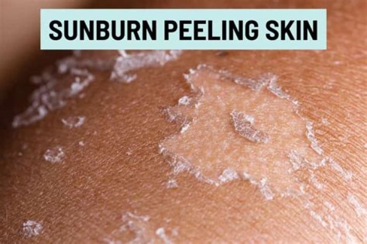Here's How to Treat Peeling Skin Post-Sunburn