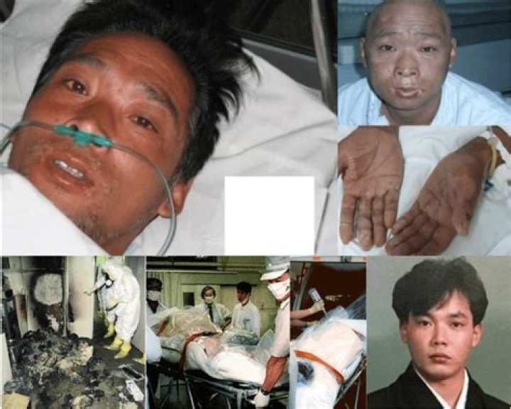 Hisashi Ouchi After Radiation Pics: The Untold Story