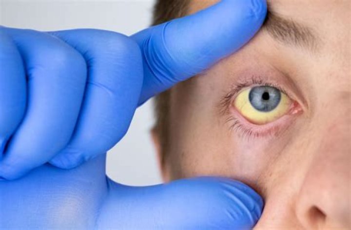 How Different Types of Anemia Affect Your Vision