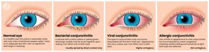 How long is pink eye contagious?