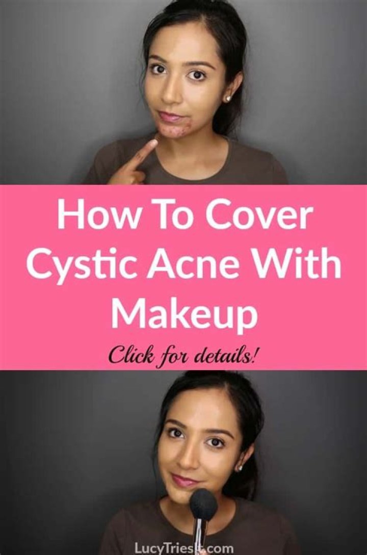 How to Cover Up Cystic Acne