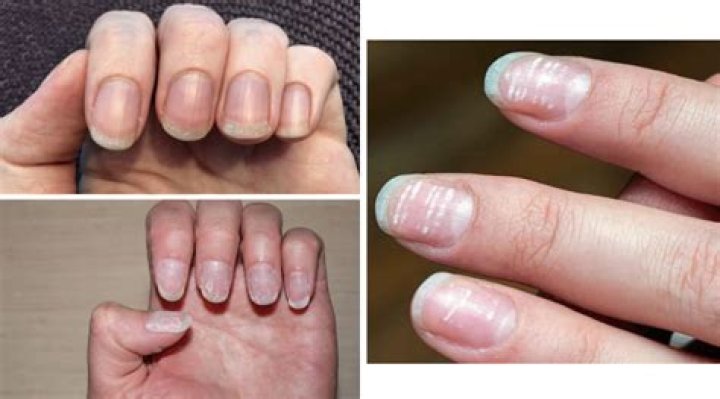 How to Treat Damaged Nails, According to Experts