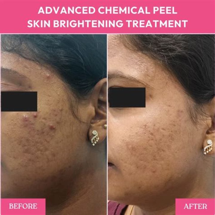 I Relied on This Healing, Ceramides-Packed Moisturizer After a Chemical Peel