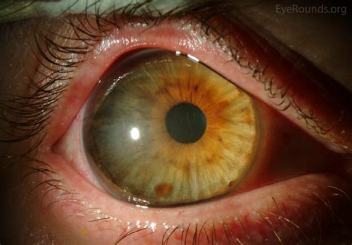 Megalocornea - All About Vision