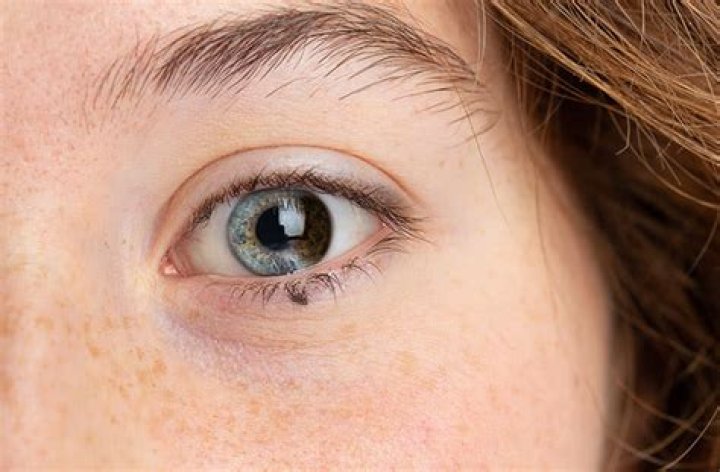 Partial Heterochromia - All About Vision