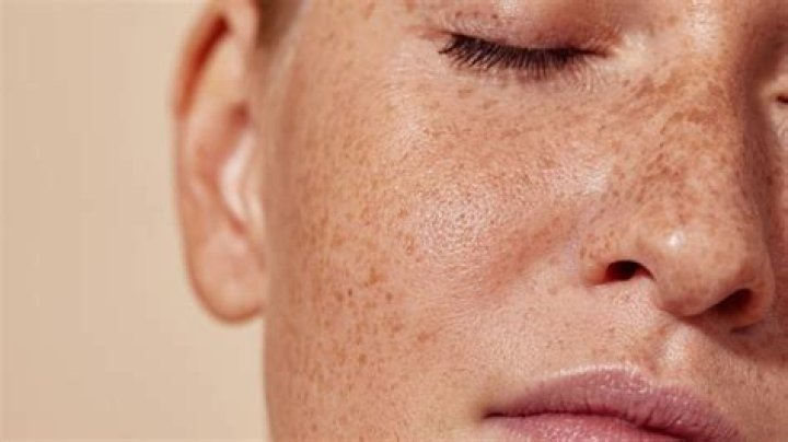 Pecas: Qué es? - Tratamiento y Precaución