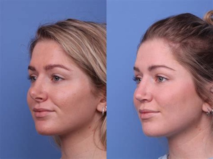 Procedure, Cost, Before and After