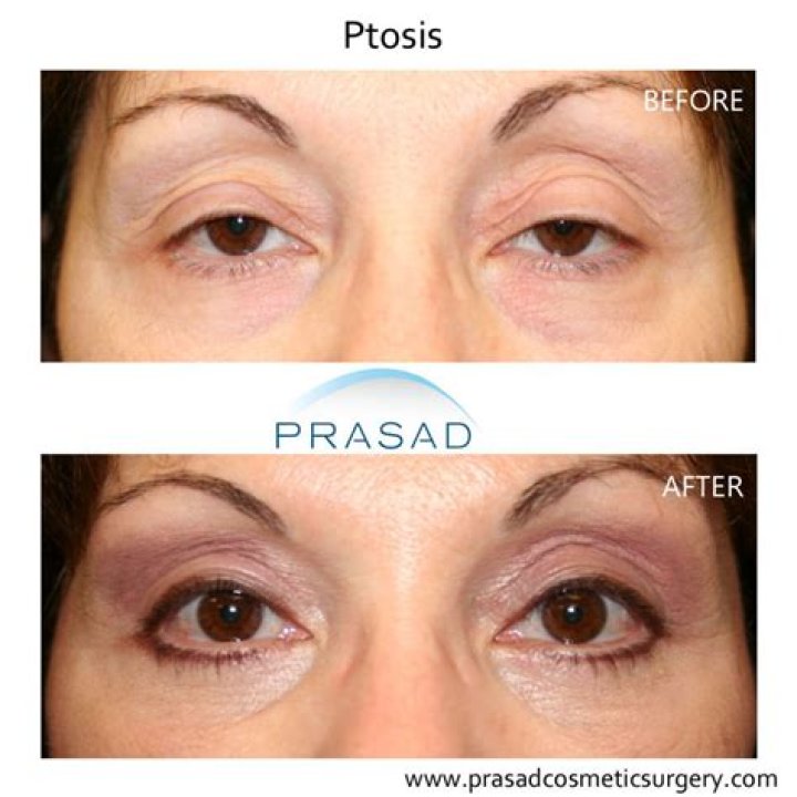 Ptosis Surgery for Droopy Eyelids