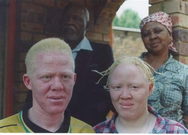 Report: Scores of albinos in hiding after attacks