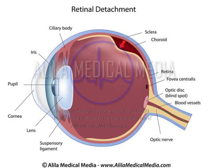 Retinal detachment FAQ