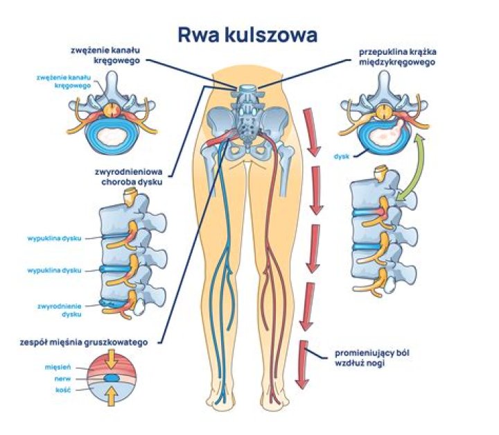 Rwa kulszowa - objawy, przyczyny i ulga