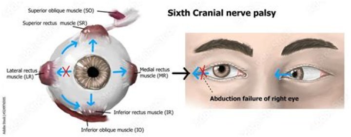 Sixth Nerve Palsy