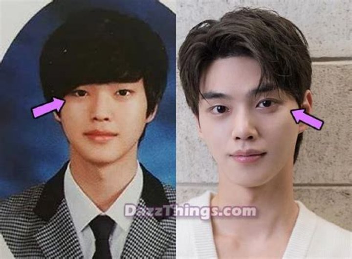 Song Kang Plastic Surgery: Truth Behind The Transformation