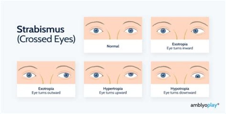 Strabismus (Crossed Eyes) - All About Vision