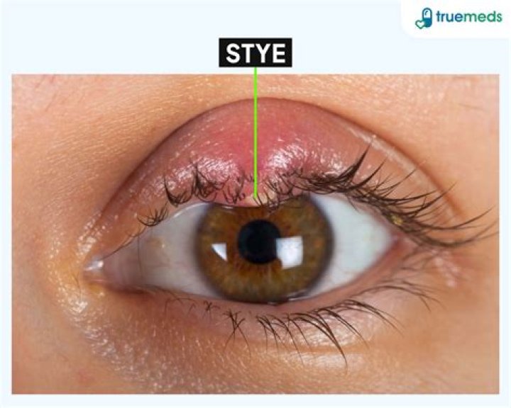 Stye Duration and Managing Recurring Styes