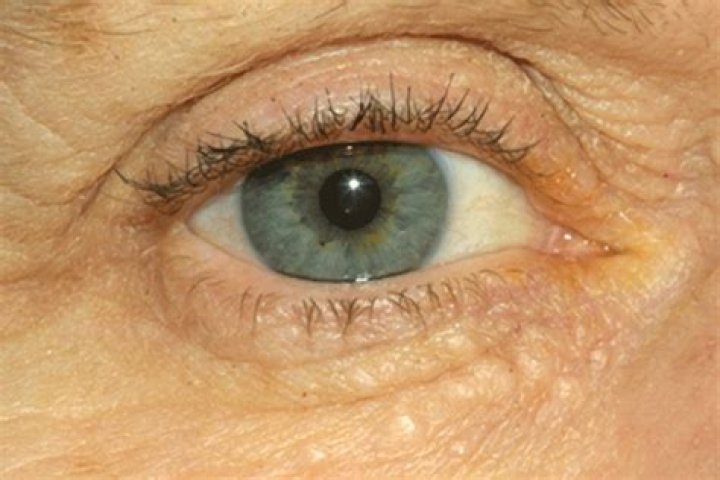 Syringoma: Condition and Treatment