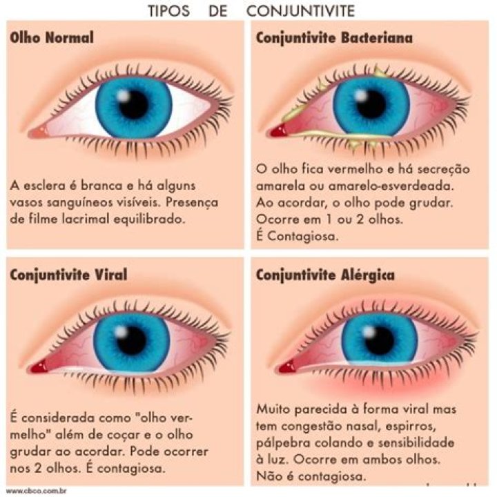 Tipos de conjuntivite: Bacteriana, viral e outras