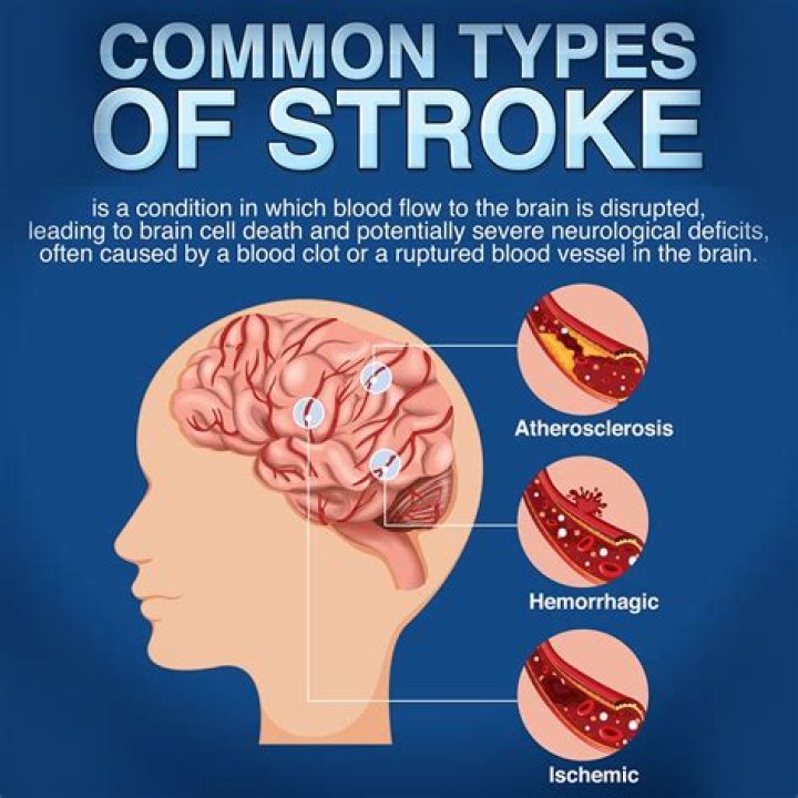 Understanding Peter's Stroke: Causes, Symptoms, And Recovery