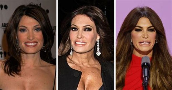 Unveiling The Truth: Did Kimberly Guilfoyle Have Plastic Surgery?