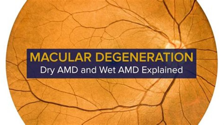 Wet Age-Related Macular Degeneration (AMD) Treatment