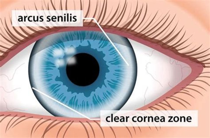 What Are Arcus Senilis and Corneal Arcus? — All About Vision