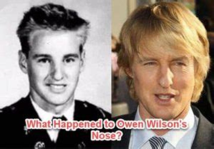 What Happened To Owen Wilson's Nose?