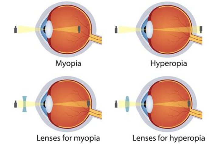What Is Progressive Myopia? - All About Vision
