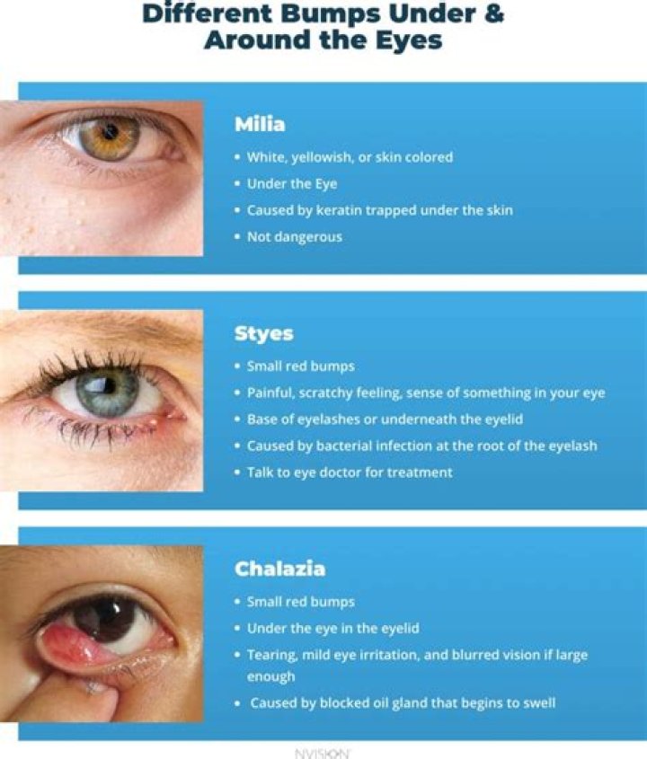 What It Means If You Have Bumps Under Your Eyes