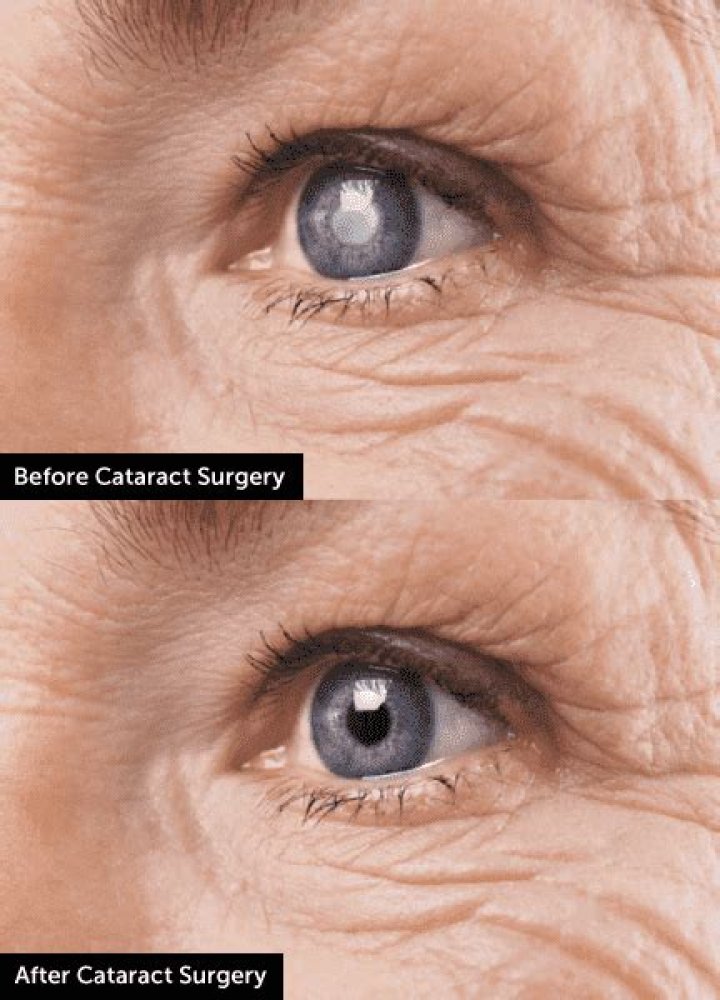 Will I Need Glasses After Cataract Surgery?